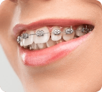 Braces