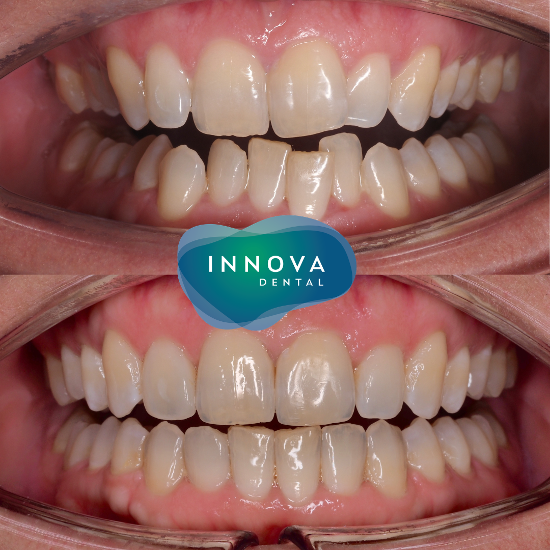 Case 1: before and after clear aligner treatment, retracted front view