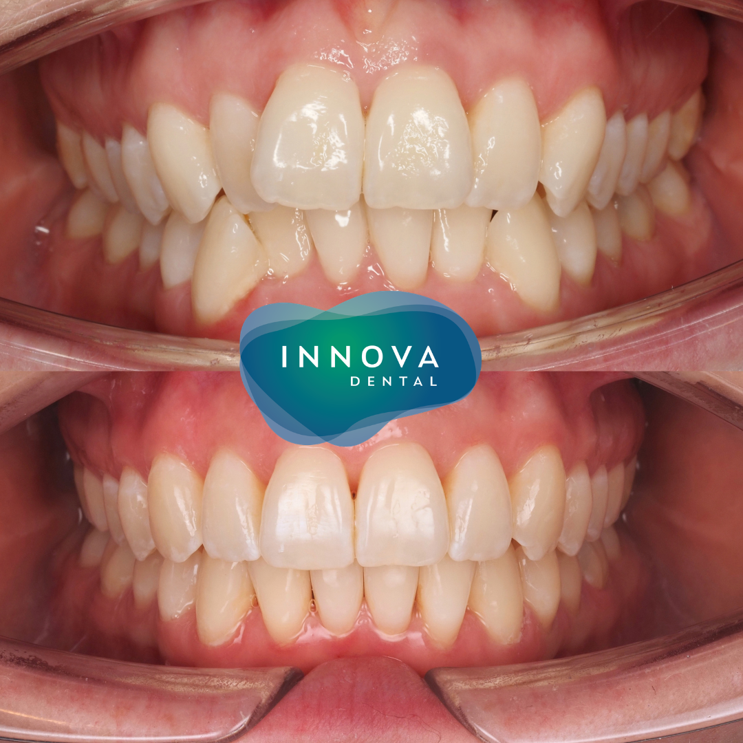 Case 2: before and after clear aligner treatment, retracted front view