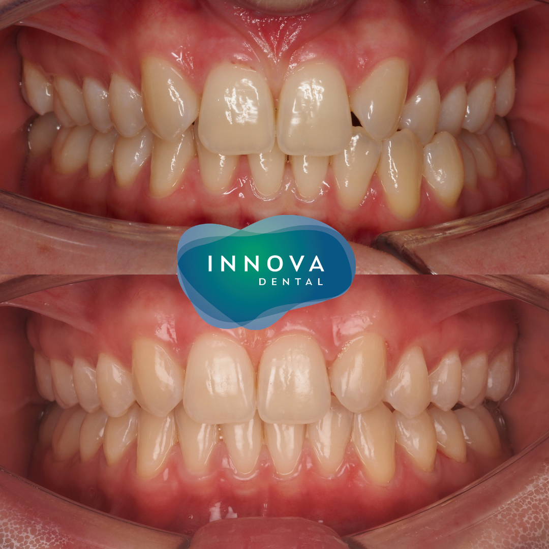 Case 3: before and after clear aligner treatment, retracted front view