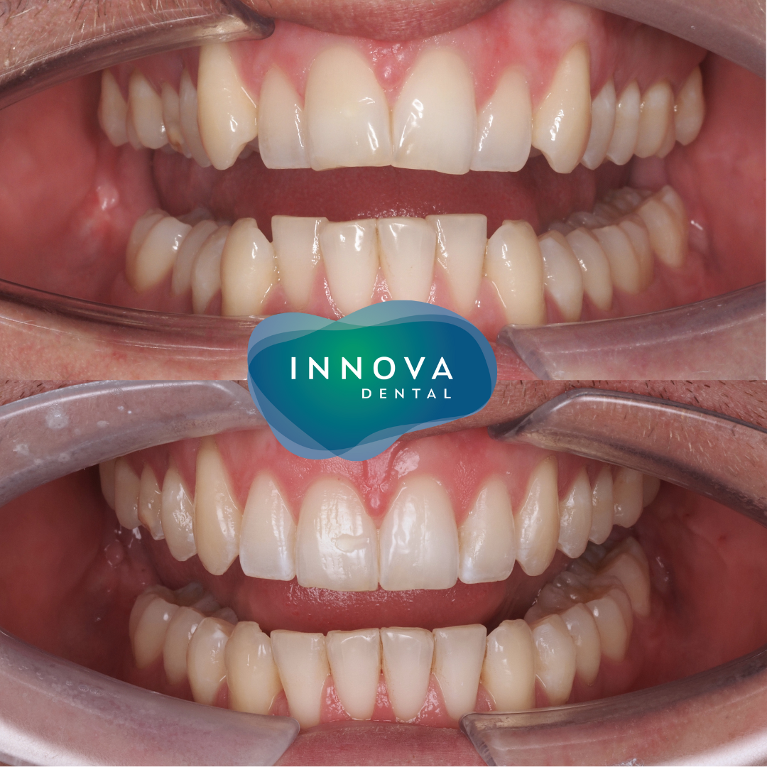 Case 4: before and after clear aligner treatment, retracted front view