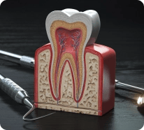 Root canal treatment