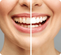 Teeth whitening
