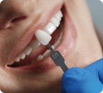 Veneers