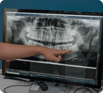 Wisdom tooth extraction